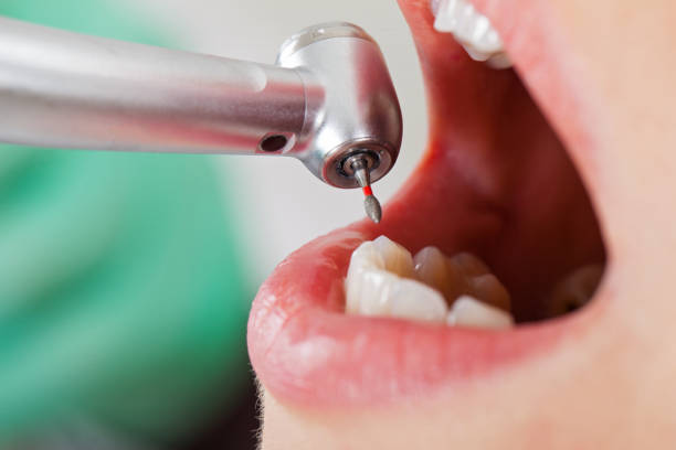 Best Emergency Treatment for Oral Infections in Spanish Lake, MO